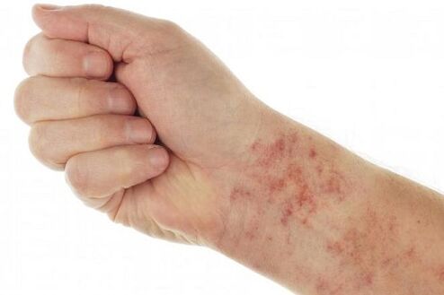 allergie dovute a parassiti nel corpo